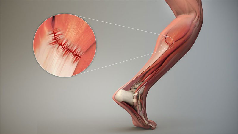 Rách cơ bắp chân ưu tiên điều trị bảo tồn để nhanh chóng hồi phục