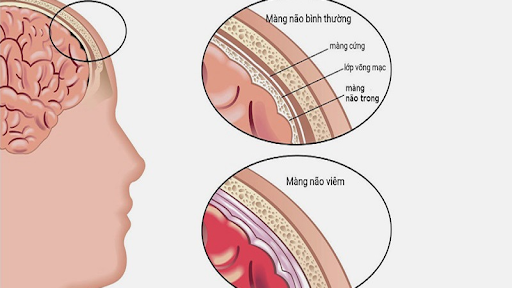 Lao màng não và chi phí điều trị lao màng não