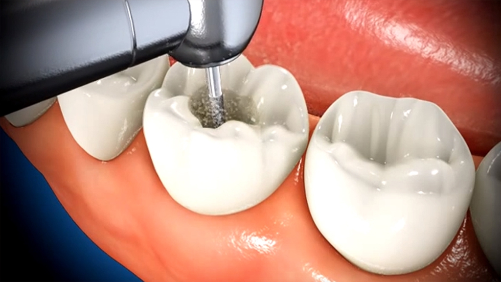 Khi nào cần trở lại thăm bác sĩ nha khoa nếu cảm thấy đau răng kéo dài sau khi lấy tủy răng lần 1?
