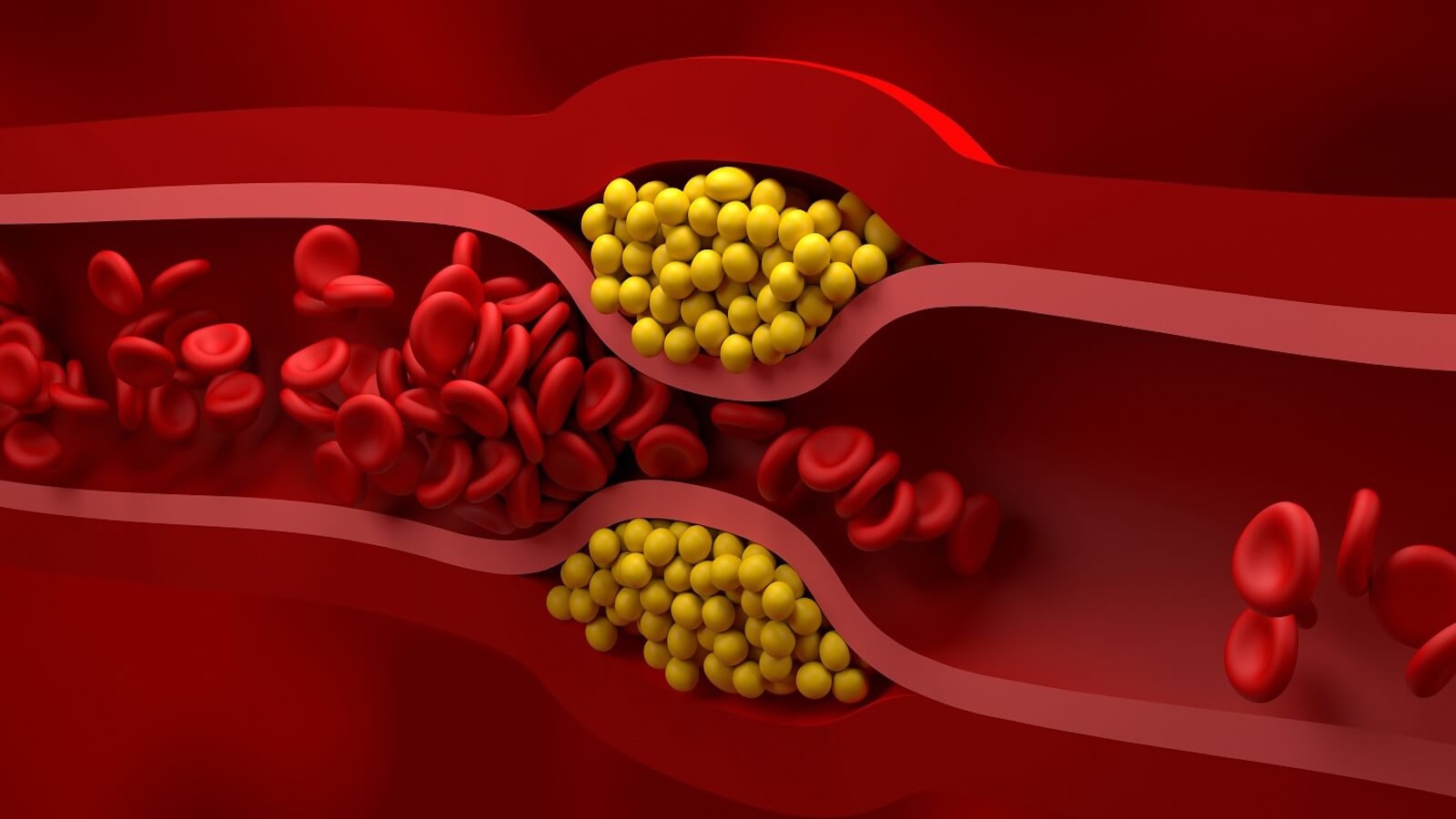 LDL cholesterol cao cảnh báo bệnh gì?