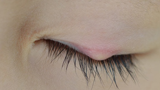 Lẹo mắt bên trong có thể gây biến chứng không?


