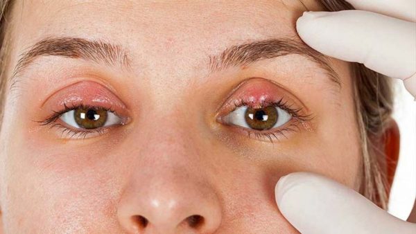 Làm sao để phòng tránh lây nhiễm lẹo mắt từ người khác?
