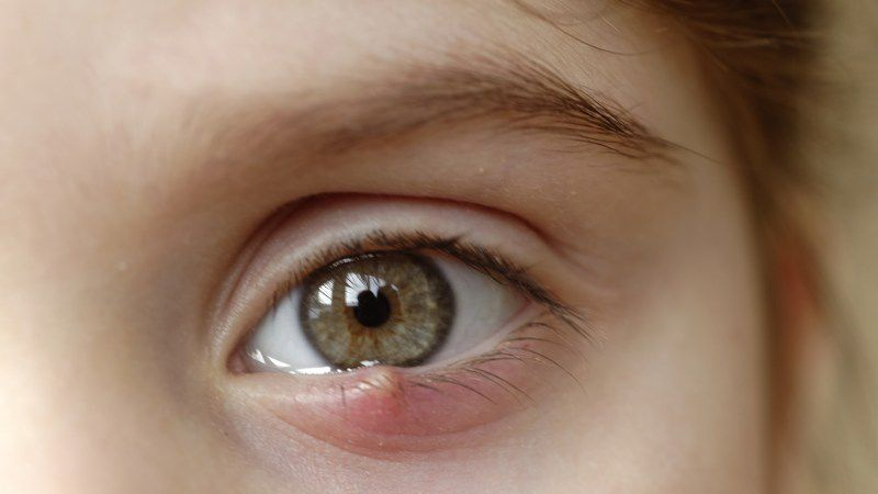 Khi nào cần thăm khám bác sĩ nếu bị lẹo mắt có mủ?
