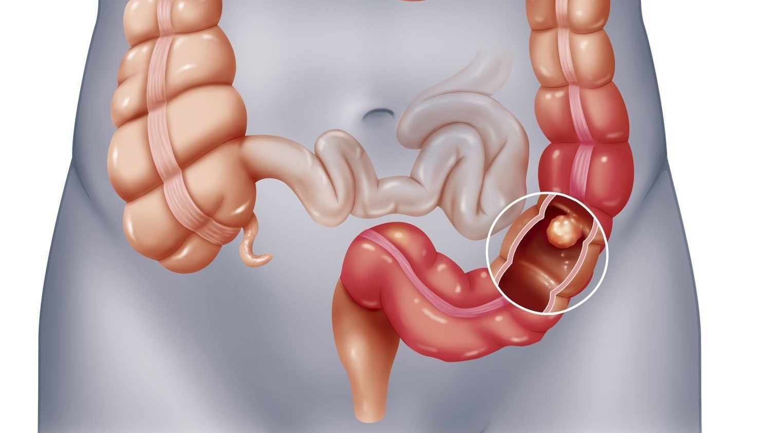 Liệt ruột sau mổ là gì? Phương pháp điều trị liệt ruột sau mổ
