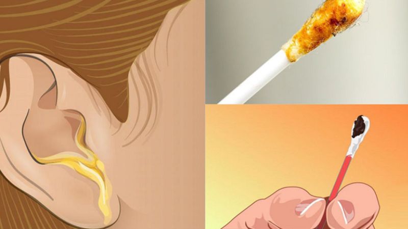 Loại bỏ ráy tai cho trẻ với dung dịch Otosan Natural Ear Drop 1