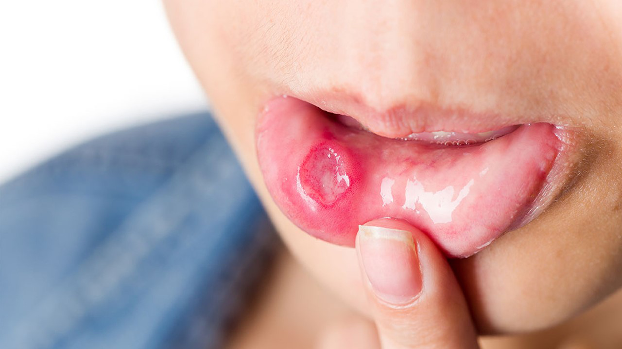 Loét miệng có thể ảnh hưởng đến chất lượng cuộc sống của bệnh nhân HIV như thế nào?
