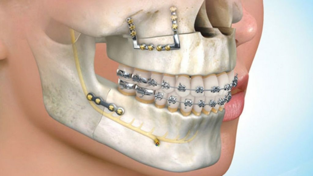 What are the risks associated with jaw surgery?