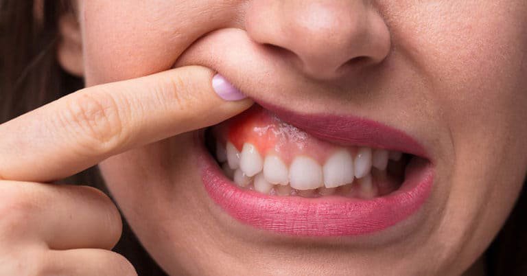 Lồi xương chân răng: Nguyên nhân và dấu hiệu nhận biết 1