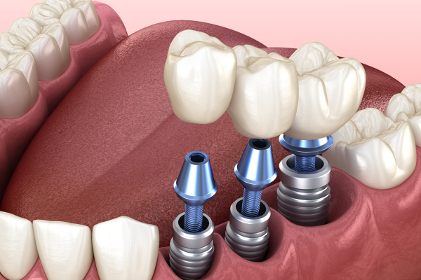 Lồi xương chân răng: Nguyên nhân và dấu hiệu nhận biết 4
