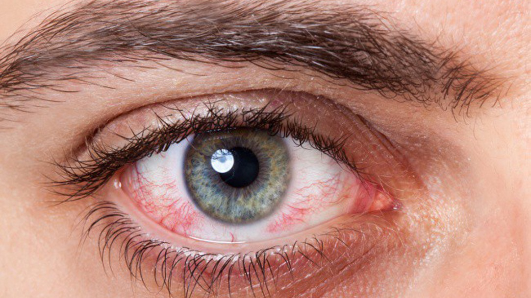 Có những biểu hiện khác nhau trong trường hợp lòng trắng mắt bị đỏ không? Nếu có, hãy liệt kê một số dấu hiệu thường gặp.
