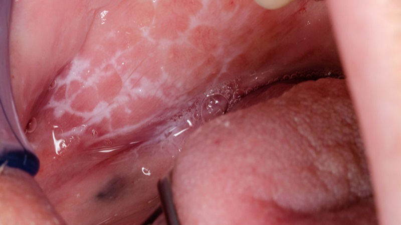 Lớp màng nhầy màu trắng bên trong miệng phát sinh do đâu? 2