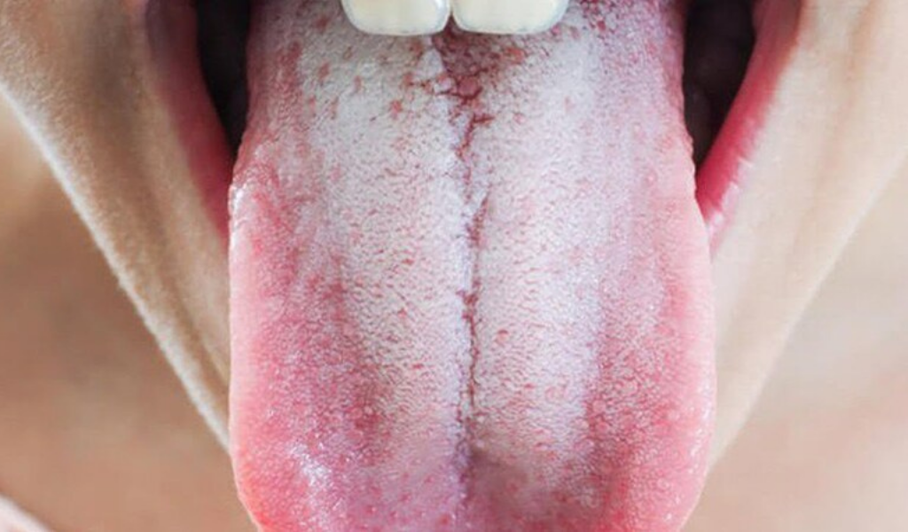 Lưỡi trắng có phát sinh ở mọi độ tuổi không?
