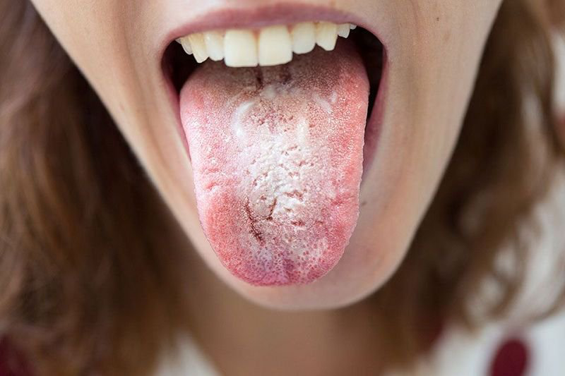 Lưỡi bình thường và các bệnh lý về lưỡi thường gặp 2