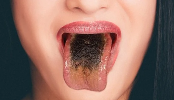 Lưỡi đen có thể tự khỏi không cần điều trị?
