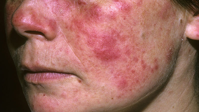 Bệnh lupus ban đỏ có nguy hiểm không?
