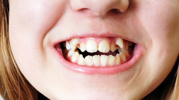 Mắc cài cánh cam: Giải pháp niềng răng thẩm mỹ và những ưu nhược điểm cần biết 4