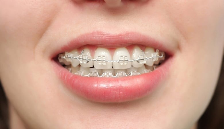 Mắc cài pha lê là gì? Tại sao nên chọn mắc cài pha lê để chỉnh nha? 1