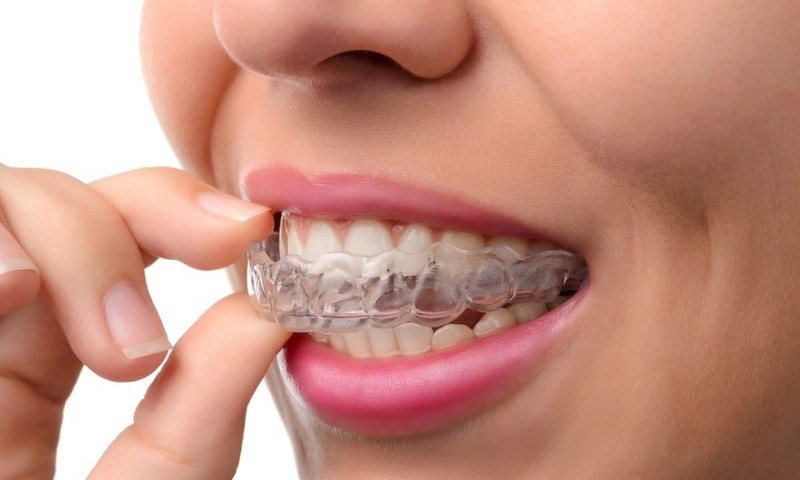 Mắc cài pha lê là gì? Tại sao nên chọn mắc cài pha lê để chỉnh nha? 4