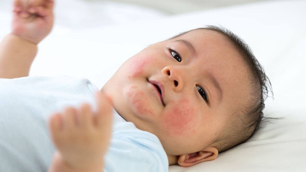 Làm sao để phân biệt hắc lào với những vấn đề da khác ở trẻ sơ sinh?
