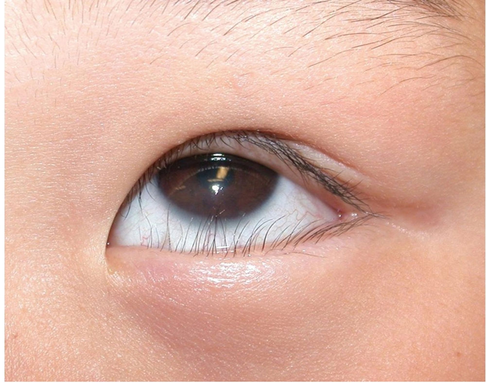 Quặm mắt có thể ảnh hưởng đến cuộc sống hàng ngày của người mắc phải không?