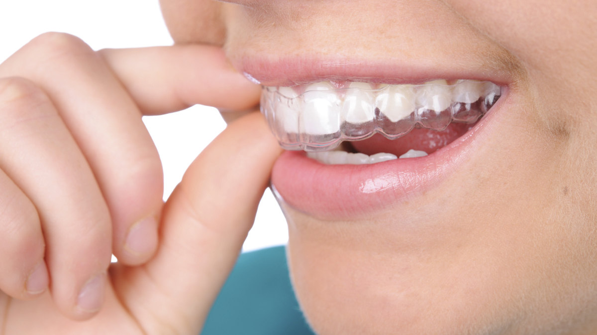 Tại sao sử dụng muối trắng trong phương pháp làm trắng răng?
