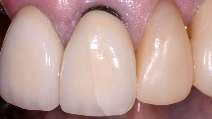 Bọt nhổ và dùng chỉ chăm sóc răng có thể giúp ngăn ngừa răng bị đen không?

