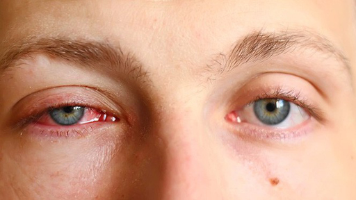 Các biểu hiện điển hình khi bé bị côn trùng cắn vào vùng mắt?
