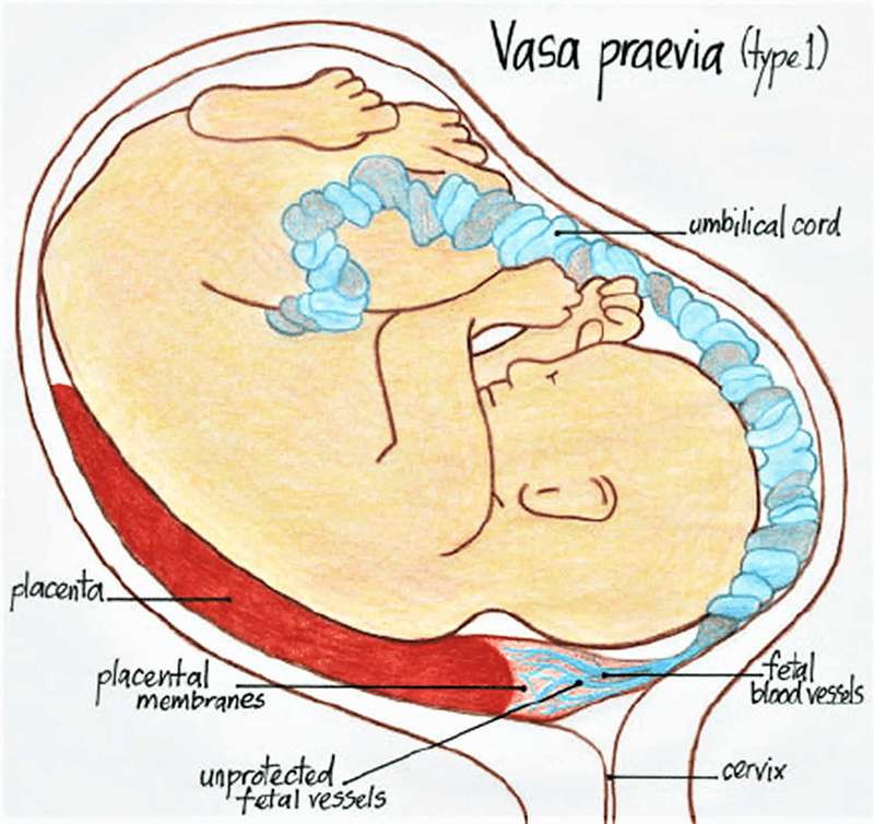 Mạch máu tiền đạo gây ảnh hưởng đến thai nhi như thế nào? 1