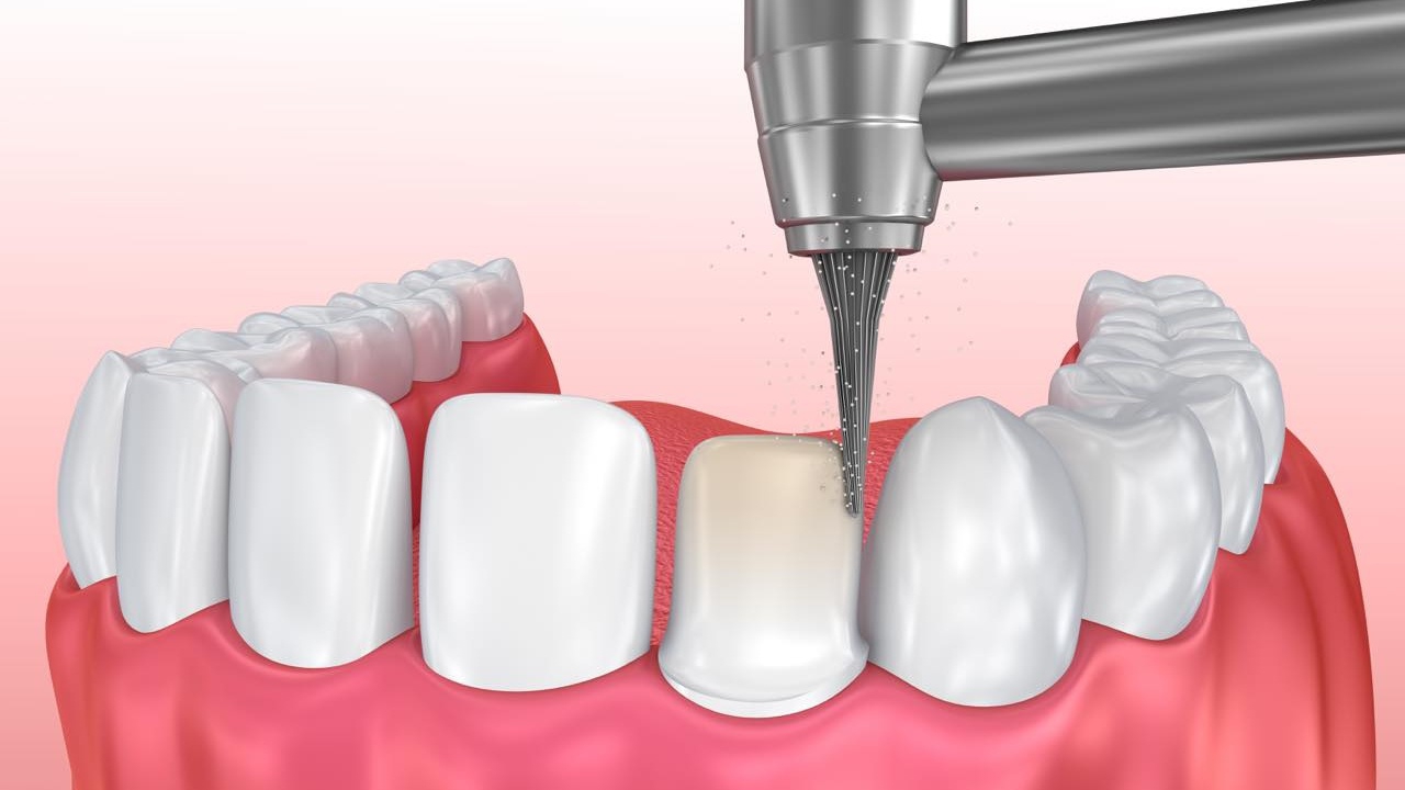 Mài cùi răng có ảnh hưởng đến sức khỏe răng miệng không?