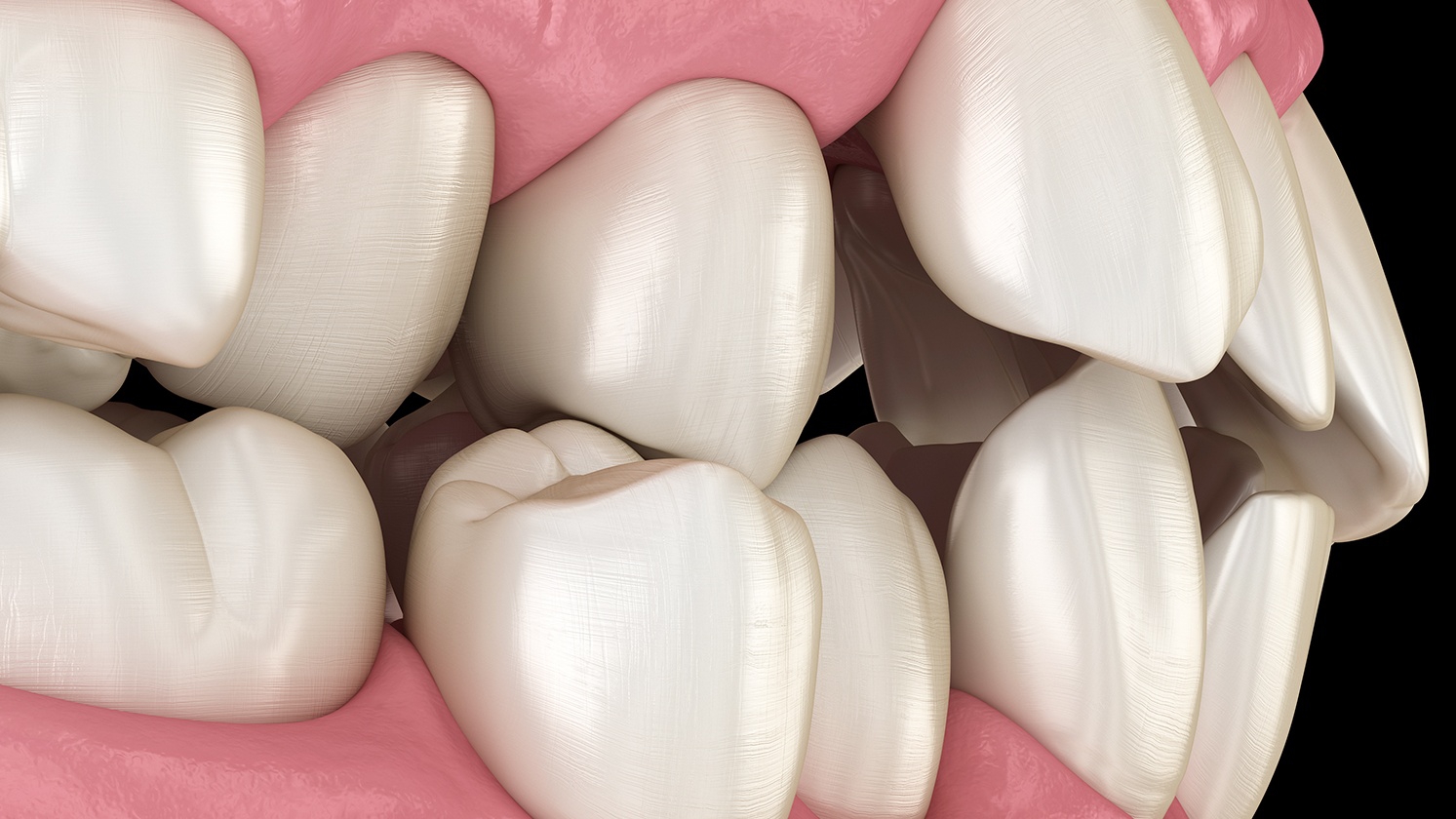 Malocclusion là gì? Điều trị Malocclusion như thế nào?