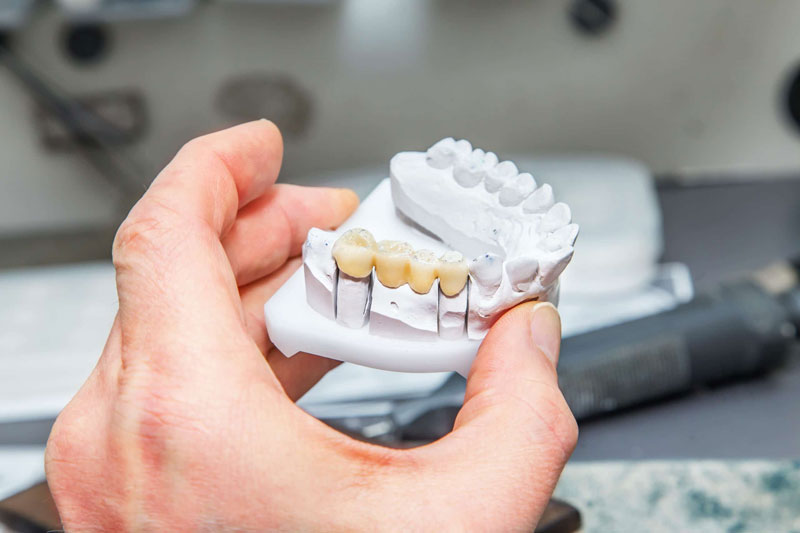 Mầm răng là gì? Thiếu mầm răng vĩnh viễn phải làm sao? 6