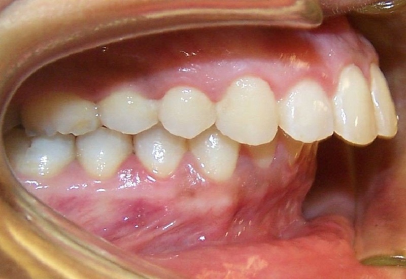 Mầm răng là gì? Thiếu mầm răng vĩnh viễn phải làm sao? 4