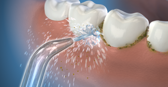 Sản phẩm chăm sóc răng đặc biệt dành cho người bị mảng bám đen có hiệu quả không?
