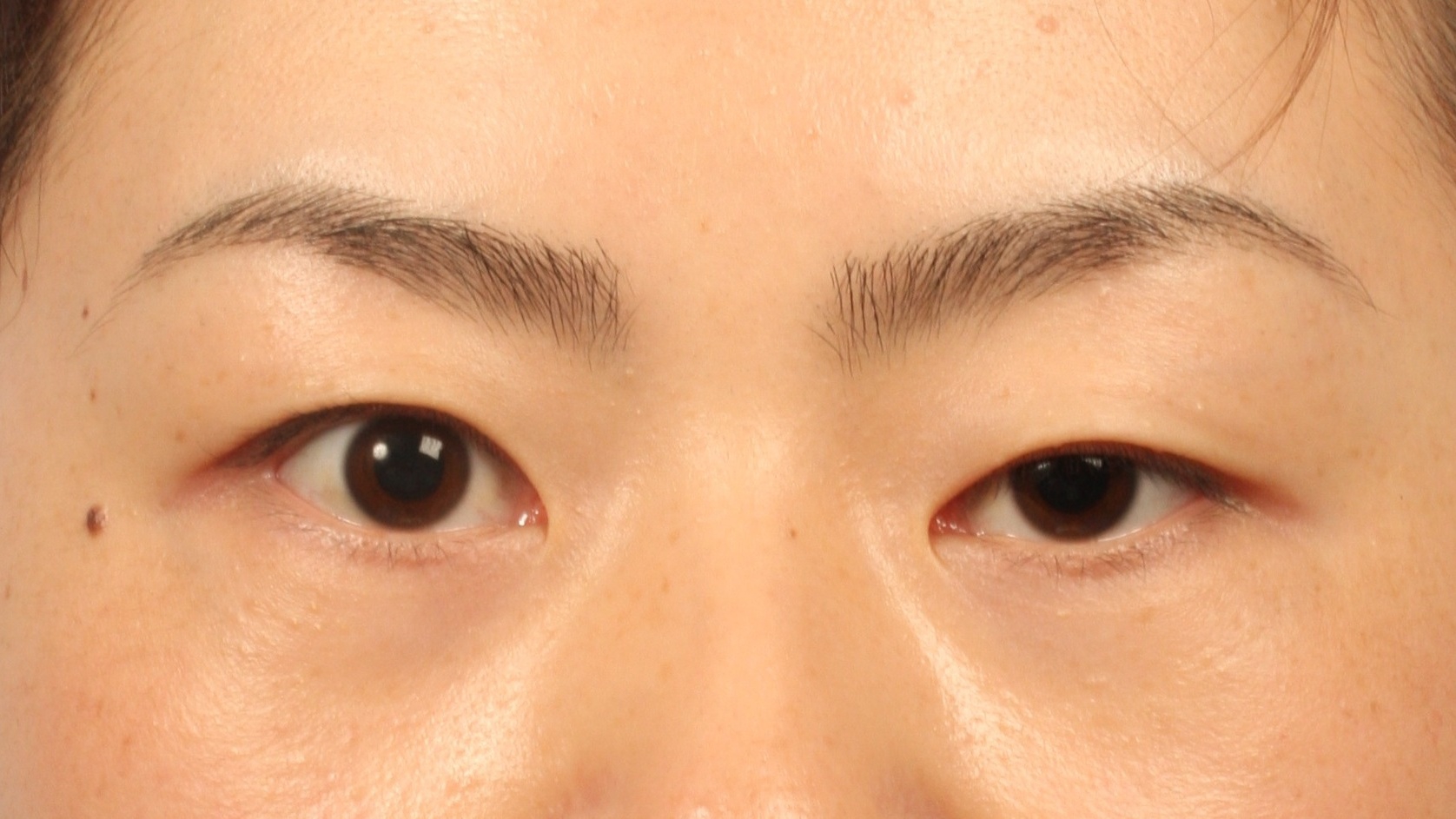What are the potential causes and risks of unsuccessful double eyelid surgery?