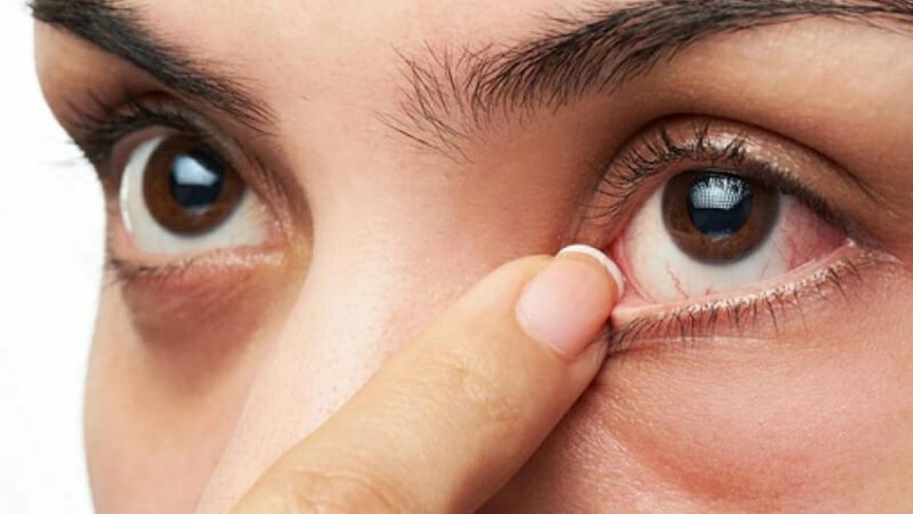 Mắt đổ ghèn sợi có phải là dấu hiệu của viêm kết mạc mắt?