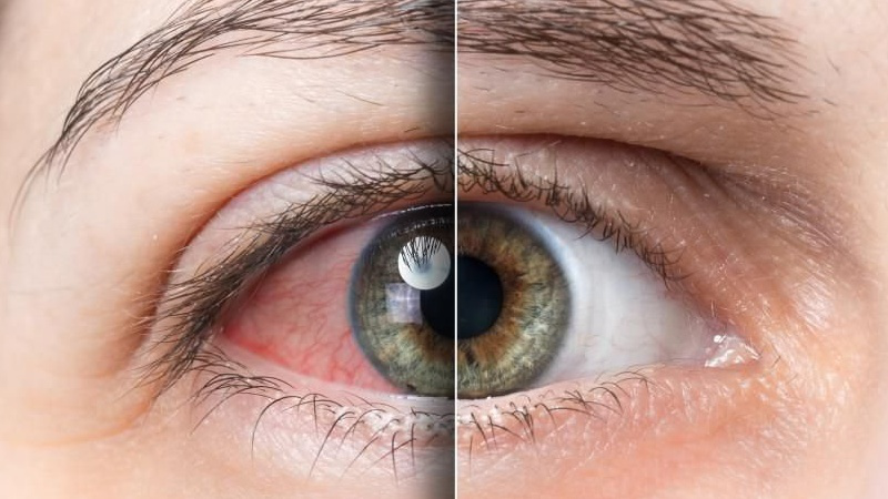 mắt bị khô rát: nguyên nhân và cách khắc phục 1