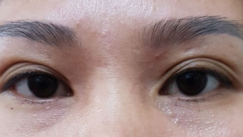Có phương pháp nào để điều trị mắt 5 mí không?
