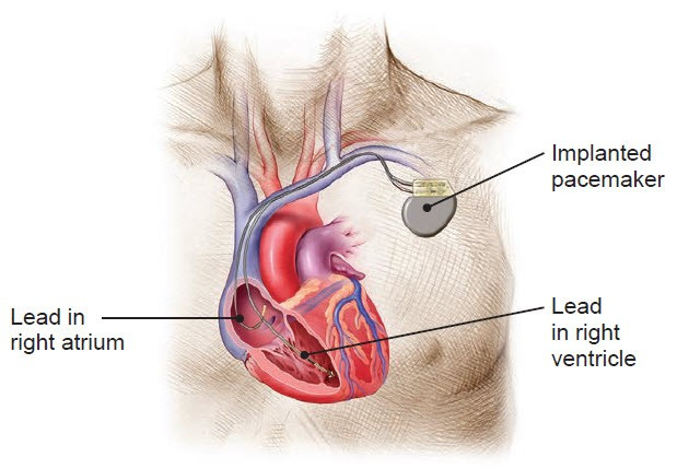Máy tạo nhịp tim có an toàn không? 3