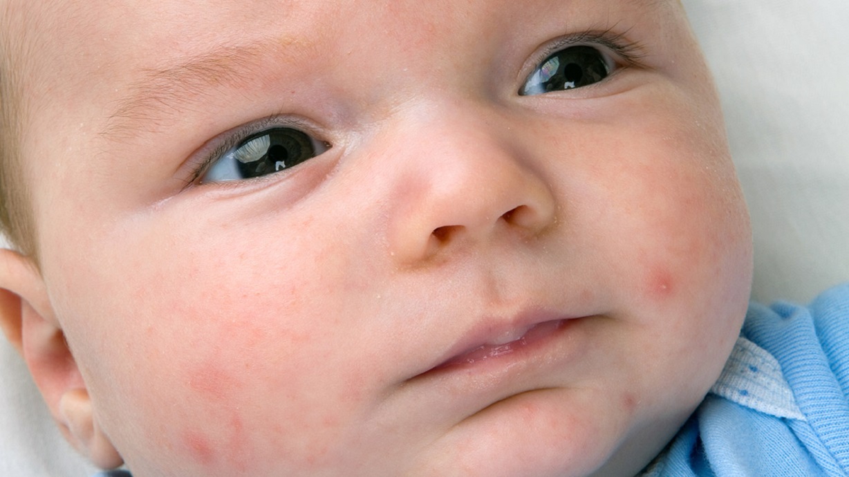 Các thực phẩm mẹ nên tránh trong việc cho con bú khi bé bị chàm sữa?
