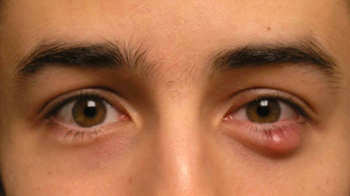 Có cách nào điều trị lẹo mắt không phẫu thuật?
