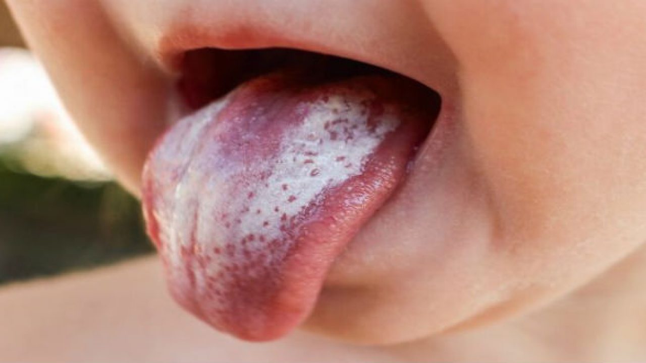 Điểm khác biệt giữa nấm miệng ở trẻ trên 1 tuổi và nấm miệng ở người lớn?
