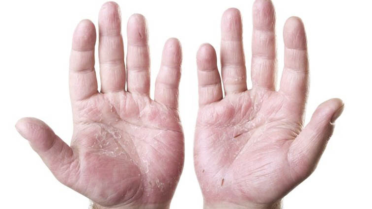 Các nguyên nhân gây da tay khô nứt nẻ chảy máu và cách xử lý hiệu quả