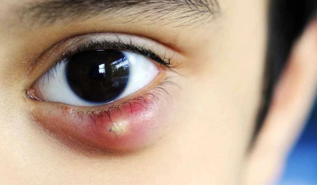 Mụn nước trong mắt có thể gây ra những vấn đề sức khỏe nào? 
