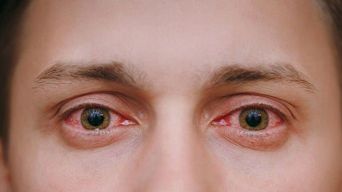 Mí mắt trên bị sưng đỏ và đau – Nguyên nhân và cách khắc phục 2