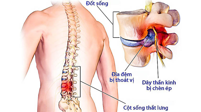 Mổ thoát vị đĩa đệm có được hưởng bảo hiểm không? 1