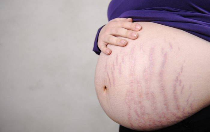 Mỡ trăn hỗ trợ trị rạn da do mang thai