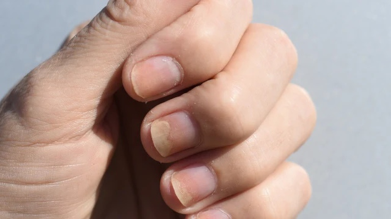 Móng tay bị tụt dần là dấu hiệu của bệnh gì và cách điều trị? 2