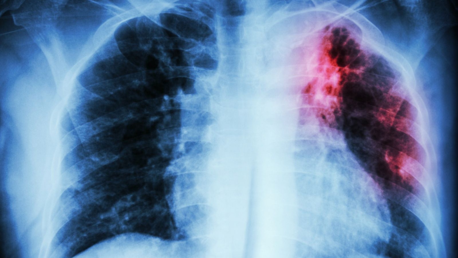 Bệnh lao ngoài phổi có phải là một biến thể nghiêm trọng hơn của bệnh lao phổi thông thường hay không?
