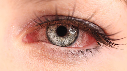 Tình trạng mắt sưng sau khi thức dậy có ảnh hưởng đến sức khỏe không?
