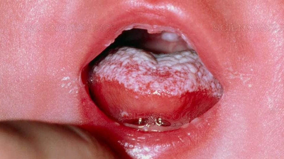 Làm thế nào để phòng tránh nấm miệng ở trẻ em 2 tuổi?
